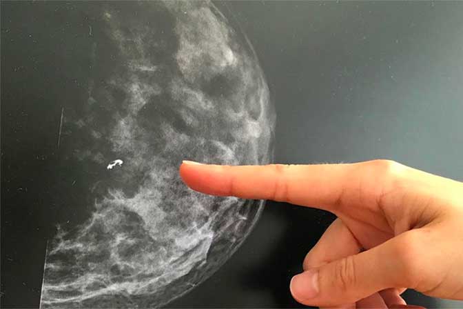 Mammogram detecting breast cancer
